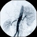 Angiogram of kidneys and aorta showing disease