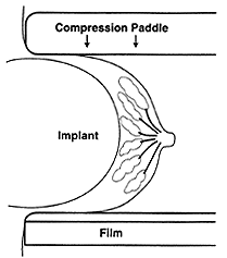 Diagram of breast with compression