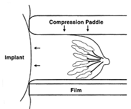 Diagram of breast implant displacement with compression