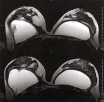Transverse high-resolution MRI scan of breast and implants
