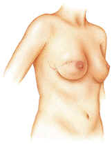 Breast reconstruction with implant
