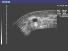 Panoramic view of a simple breast cyst within the glandular layer of breast tissue.