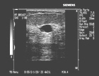 This image shows atypical characteristics of this cystic breast structure.