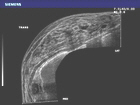 Panoramic image shows ductal and muscular layers of this high-density breast in addition to identifying multiple small cysts.