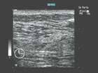 This ultrasound image shows the subtle differentiation of glandular tissue in a normal breast