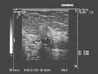 Nonpalpable (unable to be felt) mass within the glandular breast tissue