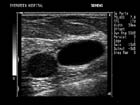 Adjacent breast masses: one a debris-filled cyst, the other a simple cyst.