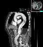 CT of aorta