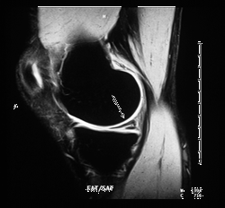 MRI image of knee showing a tear (arrow)