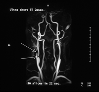 MRI of the neck showing the arteries