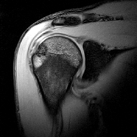 MRI of right shoulder