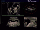 3D ultrasound image of first trimester quadruplets
