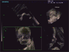 3D ultrasound image showing soft tissue of fetal face