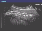 Ultrasound image of fetal spine