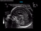 Ultrasound image of intracranial features including the cerebellum and corpus callosum