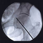 Hip fracture xray with pin in place