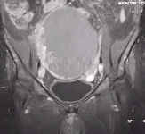 MR image of an ovarian cyst