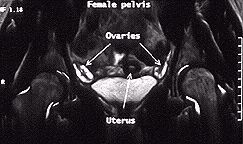 Coronal MR image of the female pelvis showing the ovaries and uterus