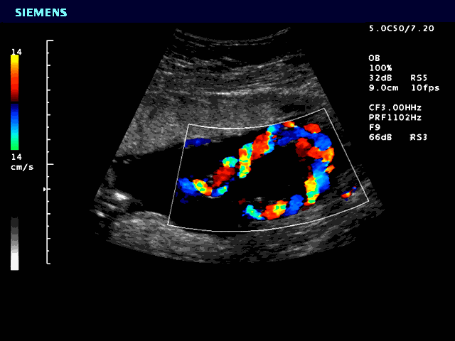 Ultrasound of the fetal umbilical cord