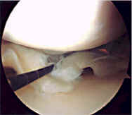 Arthoscopic image in the knee