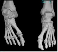 3D CT image of feet and ankles