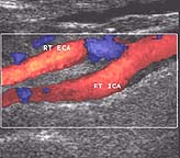 Ultrasound of carotid artery showing an stenosis in blue